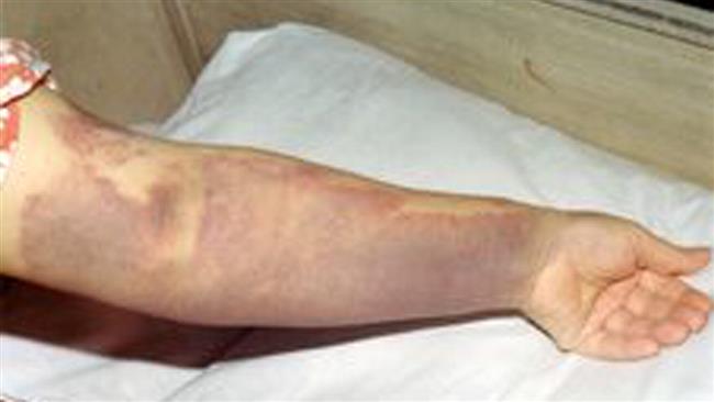 krwotoczna gorączka krymsko-kongijska 